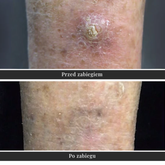 Променева терапія Sensus - лікування раку шкіри | Klinika Ambroziak