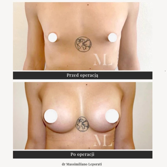 Збільшення грудей за допомогою імплантатів, пластика грудей | Klinika Ambroziak