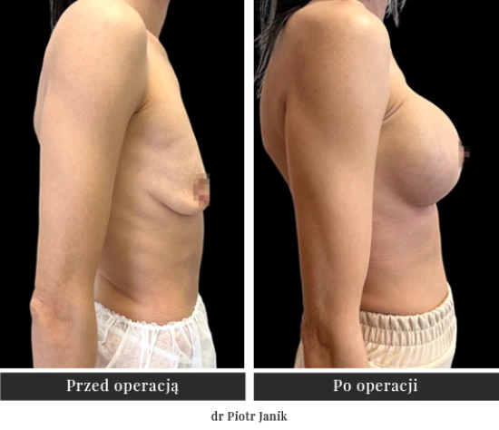 Збільшення грудей за допомогою імплантатів, пластика грудей | Klinika Ambroziak