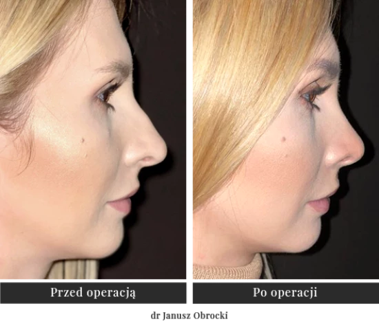 Коригувальна пластична хірургія зовнішнього носа та носової перегородки | Klinika Ambroziak